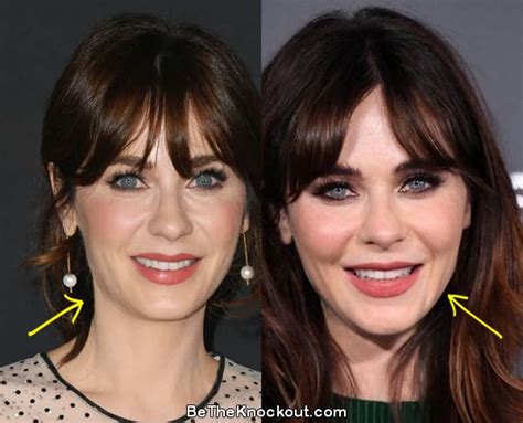 zooey deschanel filler|Zooey Deschanel Plastic Surgery: Then and Now Photos